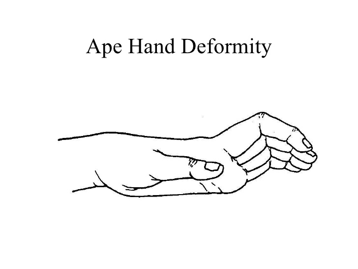 hands upper extremity